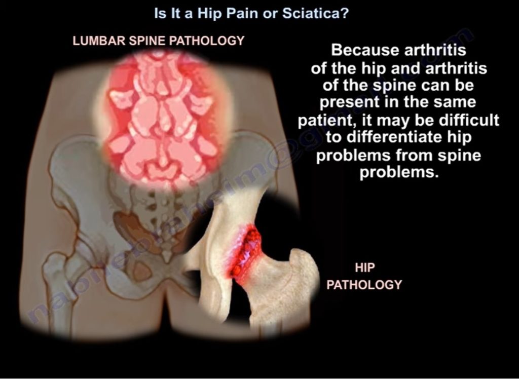 Hip Pain Vs Sciatica — OrthopaedicPrinciples.com