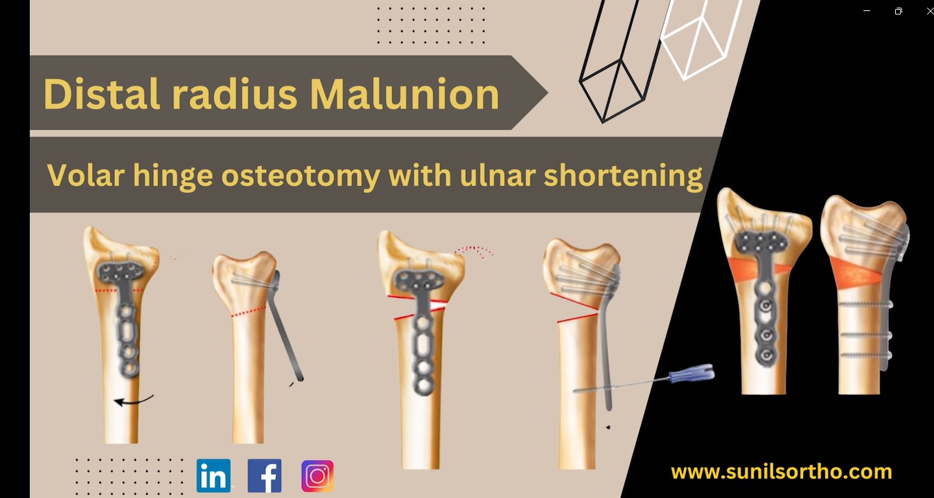 Volar Osteotomy for Distal Radius Malunion
