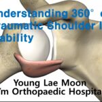 Understanding 360° of Traumatic Shoulder Instability