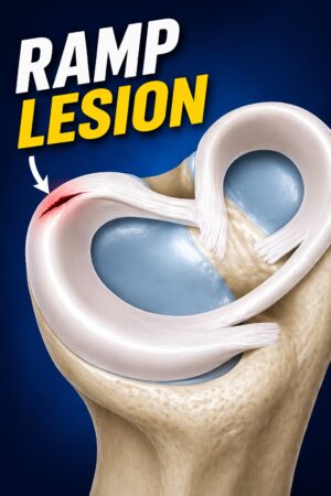 RAMP Lesions of the Meniscus — OrthopaedicPrinciples.com